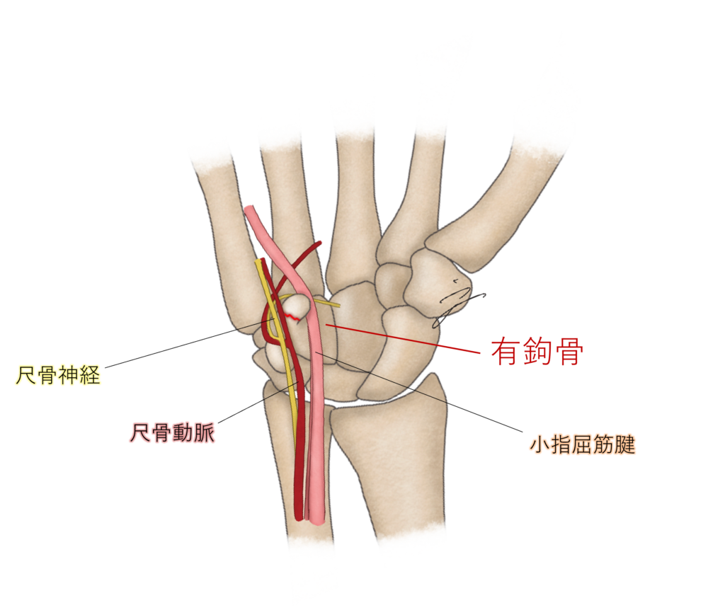 手の平が痛い 小指がしびれる 有鉤骨鉤骨折かもしれません いけ整形外科リウマチクリニック