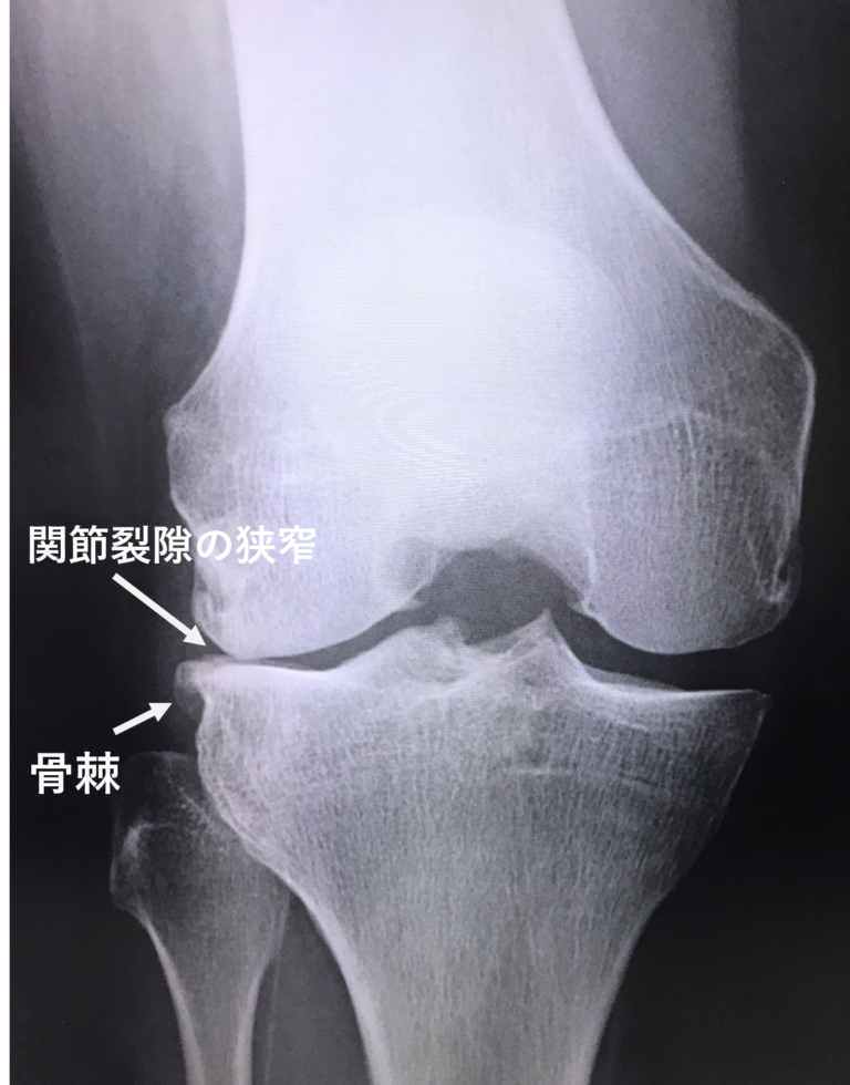 【変形性膝関節症】膝の痛み、O脚。変形性膝関節症の症状と運動療法について解説します